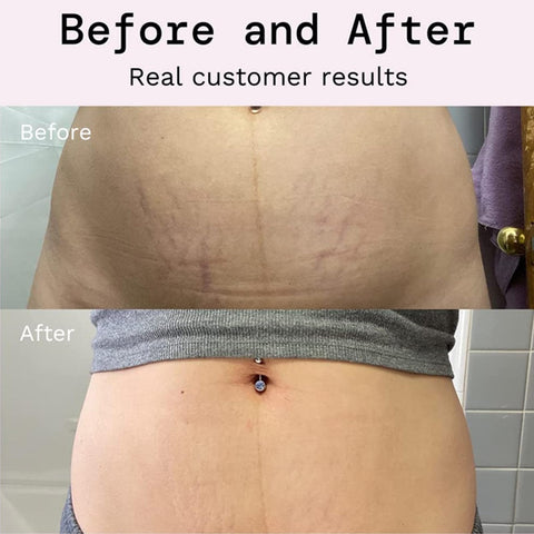 Rosarden Stretch Mark Prevention Cream for Pregnancy, Stretch Mark Cream Remover, Stretch Mark Lotion for Pregnancy, Tummy Butter for Stretch Marks Pregnancy, Shea Butter Stretch Mark Removal Cream Rosarden Stretch Mark Prevention Cream for Pregnancy, Stretch Mark Cream Remover, Stretch Mark Lotion for Pregnancy, Tummy Butter for Stretch Marks Pregnancy, Shea Butter Stretch Mark Removal Cream