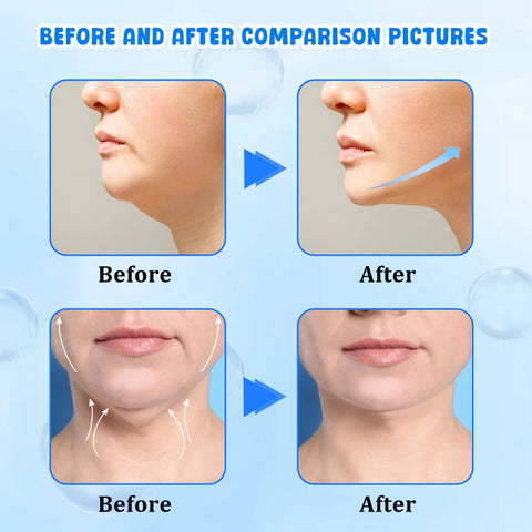 Generic 4Pcs Bloskin Double Chin Mask Reusable, Bloskin Double Chin Mask, Bloskin Lift Mask, V Line Lifting Mask for All Skin Types