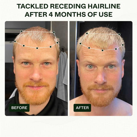 Scandinavian Biolabs Hair Growth Routine for Men - Clinically Tested with Results in 45 Days - Hair Serum for Hair Growth Based on Powerful Ingredients to Reduce Hair Loss (Bio-Pilixin)