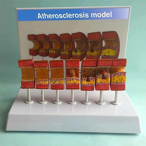 Artery Anatomy Model with Atherosclerosis Thrombus Vascular Model, 7 Parts Arterial Anatomy for Doctors, Educational Tool