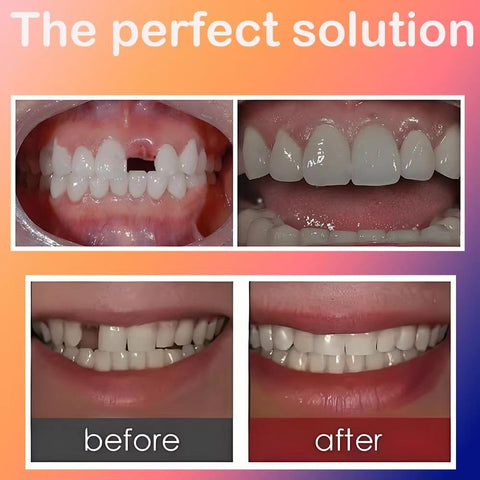 Generic ""Teeth Beauty Solution | Convenient and Portable | for Upper Teeth, Repairing Broken Teeth, Bright Smiles | Teeth Reshaping & Temporary Fix"", White