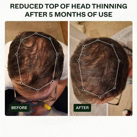 Scandinavian Biolabs Hair Growth Routine for Men - Clinically Tested with Results in 45 Days - Hair Serum for Hair Growth Based on Powerful Ingredients to Reduce Hair Loss (Bio-Pilixin)