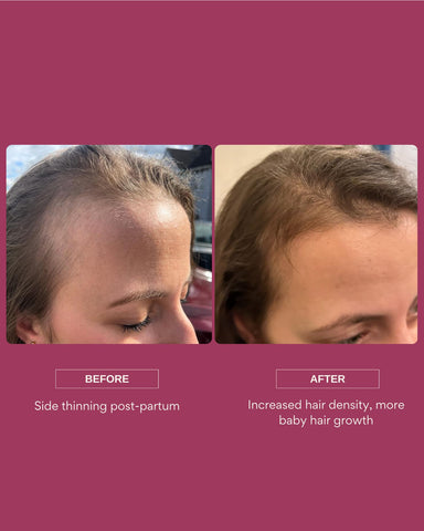 ResÃƒÆ’Ã†â€™Ãƒâ€ Ã¢â‚¬â„¢ÃƒÆ’Ã¢â‚¬Å¡Ãƒâ€šÃ‚Â¨t Scalp Serum, 50ml - Boosts Hair Growth, Targets Hair Loss & Thinning, with Caffeine, 4% AnaGainÃƒÆ’Ã†â€™Ãƒâ€šÃ‚Â¢ÃƒÆ’Ã‚Â¢ÃƒÂ¢Ã¢â‚¬Å¡Ã‚Â¬Ãƒâ€¦Ã‚Â¾ÃƒÆ’Ã¢â‚¬Å¡Ãƒâ€šÃ‚Â¢, Probiotics, Results in 90 Days