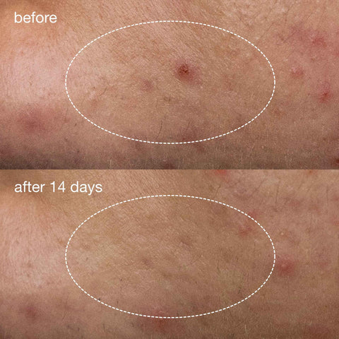 Dermalogica Deep Acne Liquid Patch, Invisible Spot Treatment for Pimple and Blemishes, Liquid to Patch Type Skin Soothing Clearing and Preventing Breakouts, Sulfur Based - 0.5 fl oz