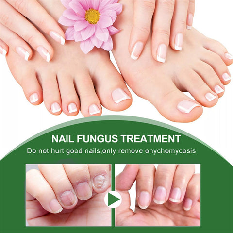 Fungal Nail Treatment - Extra Strong Nail Fungus Treatment for Toenail and Fingernail - Anti fungus Nail Repair and Strengthen, Fix & Renew Damaged, Broken Nails