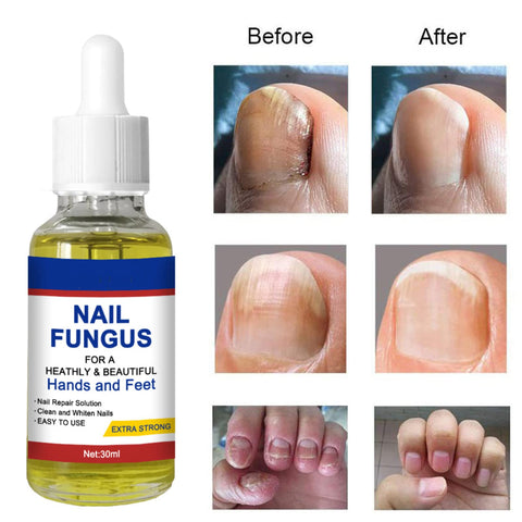 Nail Fungal Treatment, Toenail Treatment Extra Strong Nail Repair Set, Fingernail Toenail Care, Fix Renew Damaged, Broken, Anti Fungus Nail Repair (1PC)