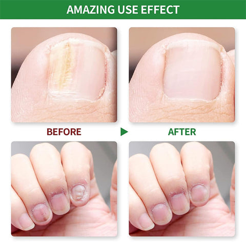 Fungal Nail Treatment - Extra Strong Nail Fungus Treatment for Toenail and Fingernail - Anti fungus Nail Repair and Strengthen, Fix & Renew Damaged, Broken Nails