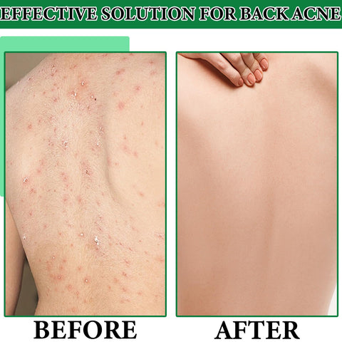 Back Acne Treatment,Back Acne Spray with Salicylic & Tea Leaf Oil Formula,Salicylic Acid Spray,Acne Body Spray Bacne Spray Natural Acne Treatment,Acne Spray for Back and Body