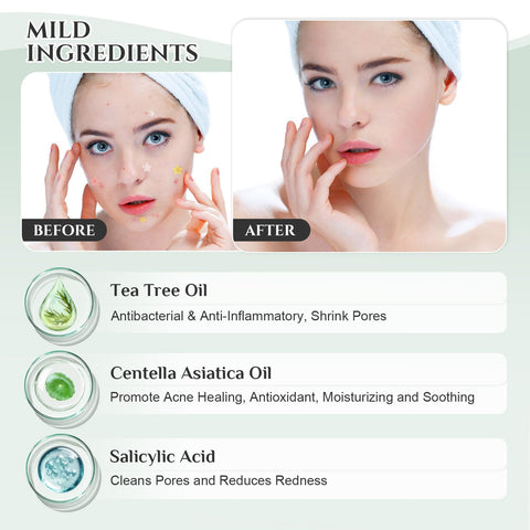 Generic Star Acne Patches 5 Colors, Hydrocolloid Pimple Patches for Face and Skin Care Acne Spot Dots Cute Face Stickers Blemish Cover 10mm/12mm/14mm Absorbing Zit Patches (400 Count)