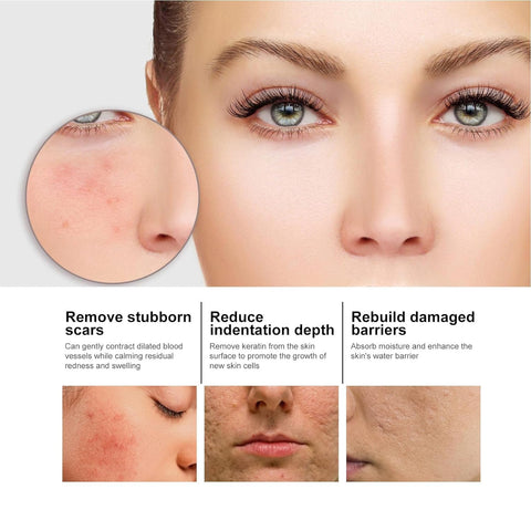 2PCS Nicotinamide Serum for Blemishes,Deeply Hydrating,Niacinamide Freckles Removal Serum,Sunnylas Niacinamide Freckles Removal Serum,for All Type Skin