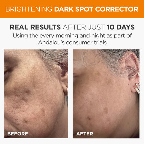 Andalou Naturals Dark Spot Corrector, Brightening Face Serum with Vitamin C, Hyperpigmentation Treatment to Even Skin Tone & May Help Reduce Appearance of Acne Scars, Age Spots & UV Damage, 1 Oz