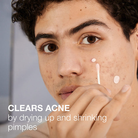 Neutrogena Stubborn Acne Spot Drying Lotion, Fragrance-Free Sulfur Acne Treatment Clears Acne By Drying Up & Shrinking Pimples, Paraben- & Oil-Free, 10% Sulfur & 4% Niacinamide, 1.0 fl. oz