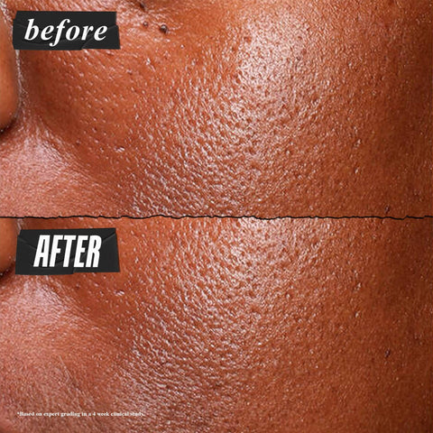 Kiehl's Ultra Pure High-Potency 5.0% Niacinamide Serum, Concentrated Face Serum for Oily Skin, Reduces Excess Oil and Shine, Helps Minimize Imperfections for a Natural Glow, Paraben-Free - 1 fl oz